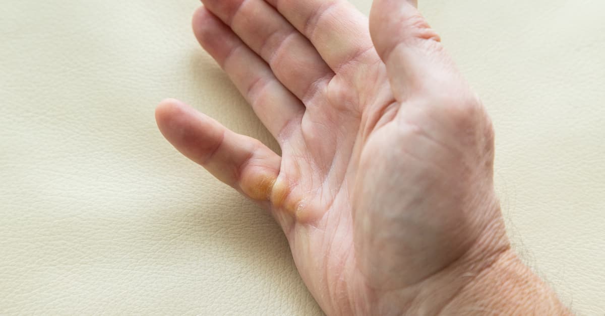 dupuytren's contracture specialist boise